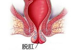 山西肛泰肛肠医院：不痛时期的脱肛有哪些不同的症状？