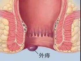 山西肛泰肛肠医院：菊花残满“腚”伤，肛门为何硬硬作痛