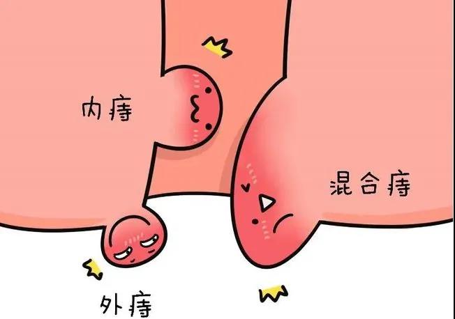 山西肛泰肛肠医院：经常上厕所不专心  小心成为有“痔”青年