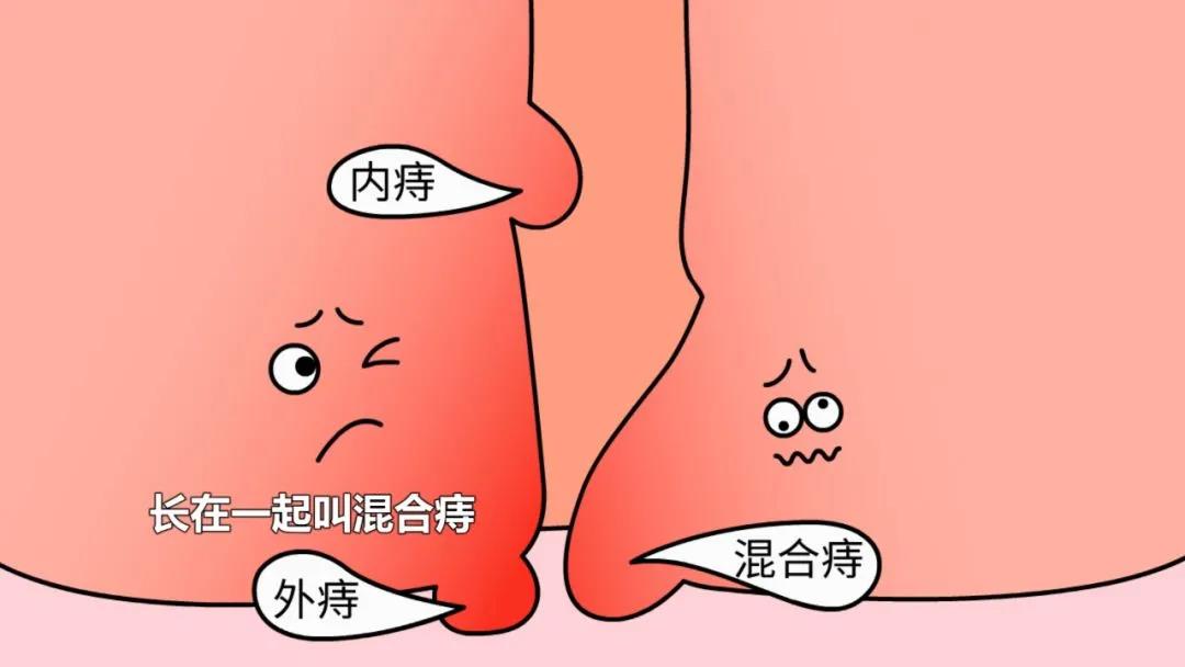 山西肛泰肛肠医院：老年人为什么容易患痔疮？老年人如何预防痔疮？