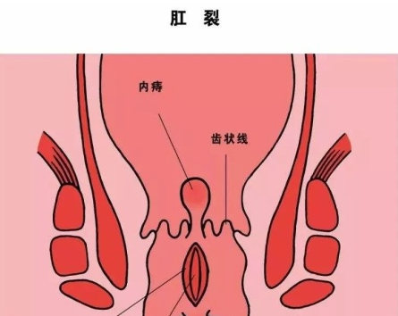 山西肛泰肛肠医院:肛裂会出现哪些症状？