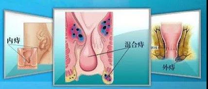 山西肛泰肛肠医院：混合痔五大症状，五大危害，不治你扛不住