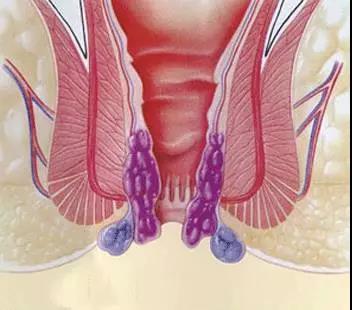 山西肛泰肛肠医院：内痔是怎么形成的？