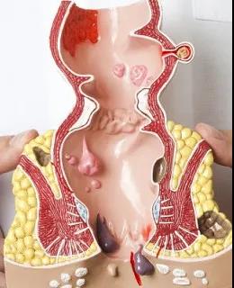 山西肛泰肛肠医院：肛瘘怎么治疗好？肛瘘的分类