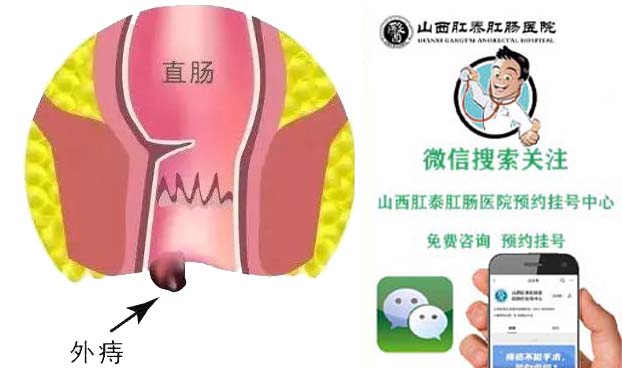 山西肛泰肛肠医院：有用的小“痔”识