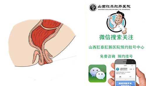 山西肛泰肛肠医院：大便时肛门有东西脱出来咋回事？