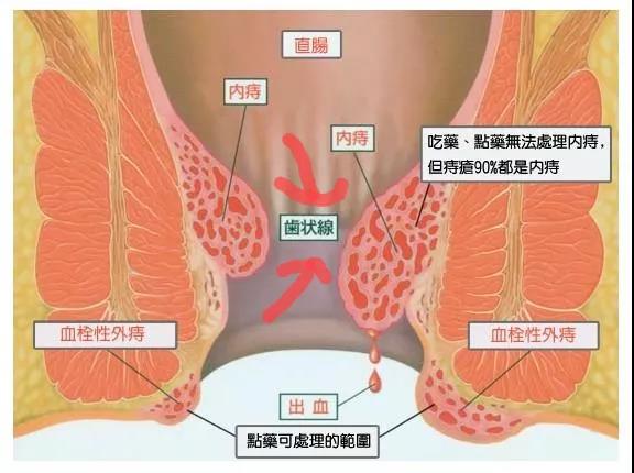 山西肛泰肛肠医院：如何区分“痔疮三兄弟”
