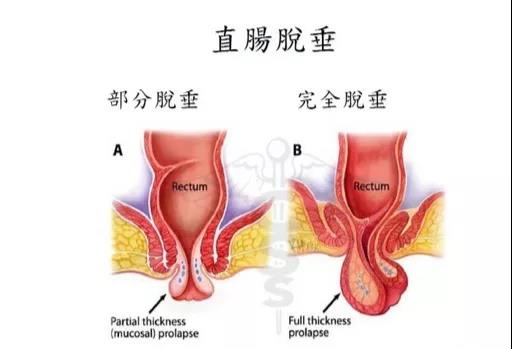 山西肛泰肛肠医院：肛门掉肉球，竟然是直肠