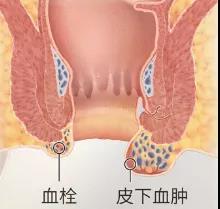 山西肛泰肛肠医院：外痔会慢慢变小吗？正确认识外痔很重要！