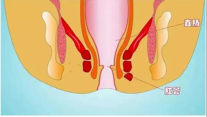 山西肛泰肛肠医院：肛痿，据说它比痔疮危害大！
