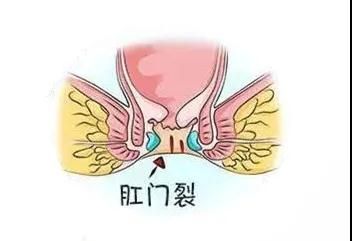 山西肛泰肛肠医院：什么是肛裂？肛裂可以分为哪几种？