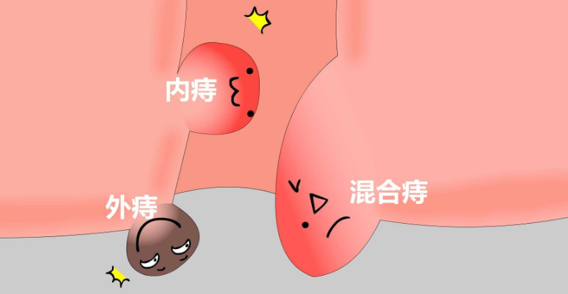 山西肛泰肛肠医院：痔疮到哪个阶段需要手术？
