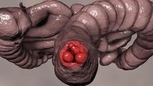 山西肛泰肛肠医院：嵌顿血栓混合痔严重吗？怎么治疗和护理？